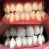 Erfahrung von Diamond Smile Zahnbleaching Power+ Phone Bleaching Mundstück - Mund mit Vorherbild Nachherbild von weißen Zähnen