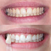 Diamond Smile Zahnbleaching Power+ Phone Bleaching Mundstück - Mund mit Vorherbild Nachherbild von weißen Zähnen