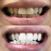 Ergebnis Diamond Smile Zahnbleaching Schaum - Vorherbild Nachherbild von weißen Zähnen