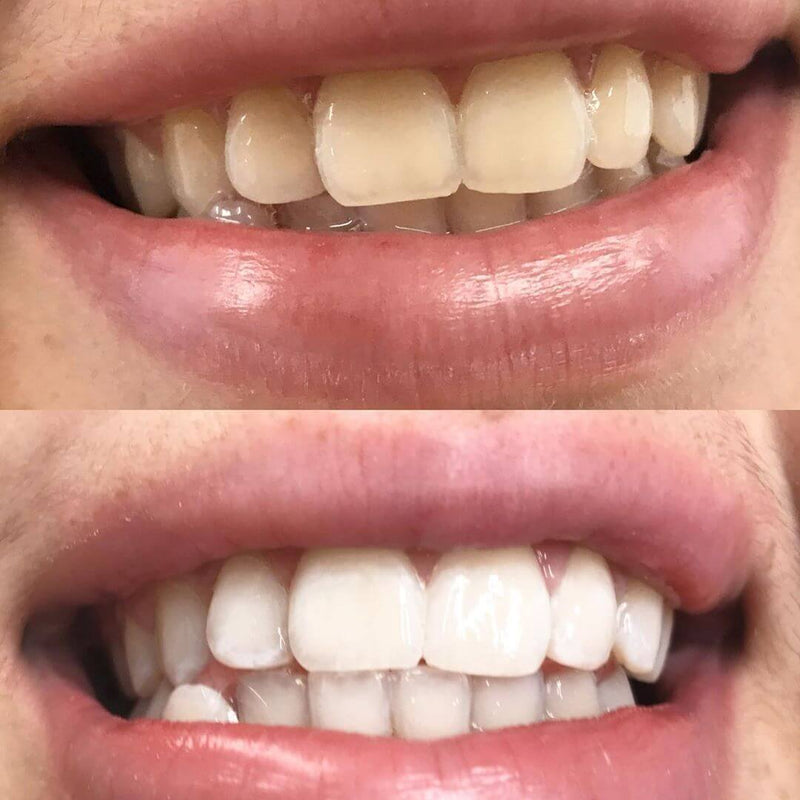 Diamond Smile Zähne aufhellen Erfahrung - Mund mit Vorherbild Nachherbild von weißen Zähnen
