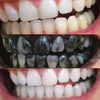 Zahnbleaching - Zahnaufhellung durch Aktivkohle
