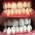 Weiße Zähne nach dem aufhellen mit einem Zahnbleaching Set und Zahnbleaching Gel.