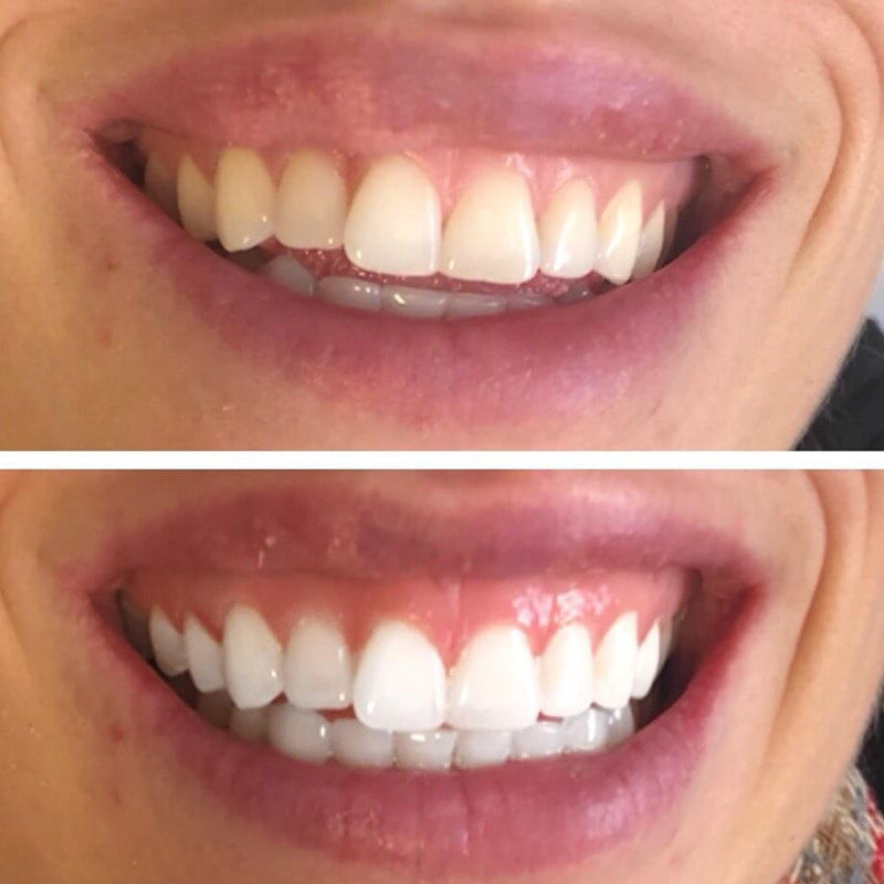 Diamond Smile Ergebnis Vorher Nachher Zahnbleaching Streifen zur Zahnaufhellung für zu Hause