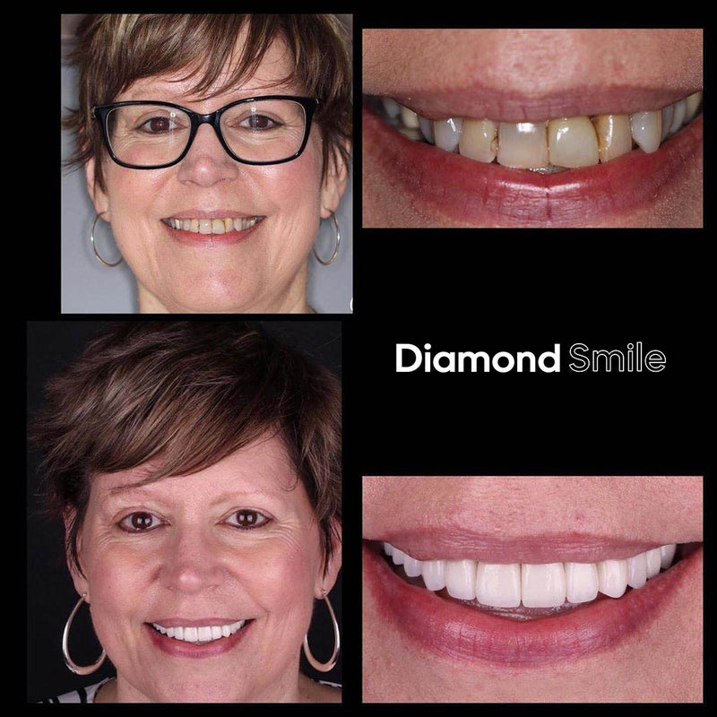 Resultat von Diamond Smile Zahnbleaching Power+ Phone Bleaching Mundstück - Mund mit Vorherbild Nachherbild von weißen Zähnen
