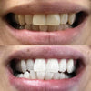 Erfahrung Zahnbleaching Streifen zur Zahnaufhellung für zu Hause