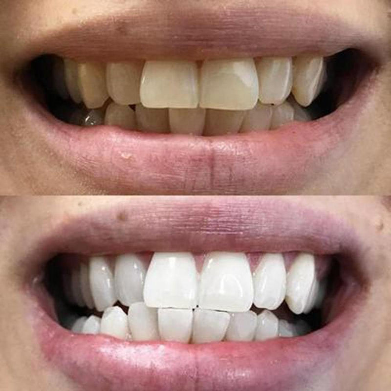 Erfahrung Diamond Smile Zahnbleaching Streifen zur Zahnaufhellung für zu Hause