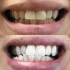 Diamond Smile Ergebnis Vorher Nachher Aktivkohle Zahnbleaching Streifen zur Zahnaufhellung
