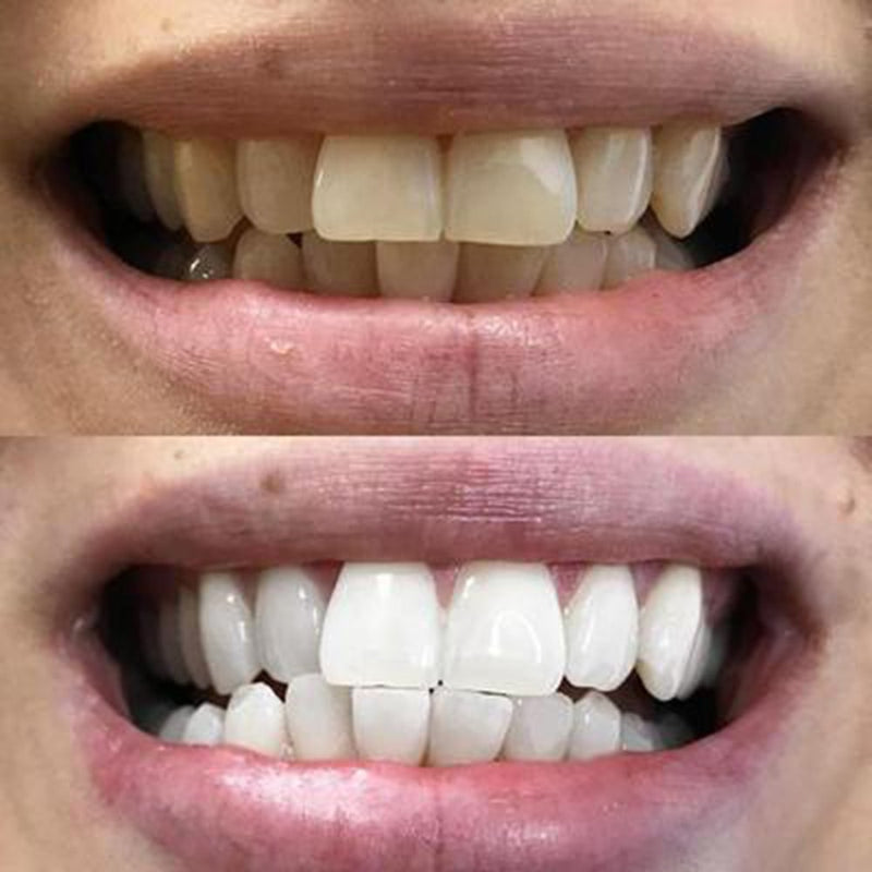 Ergebnis Diamond Smile Zahnbleaching Schaum - Vorherbild Nachherbild von weißen Zähnen