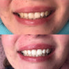 Erfahrung Vorher Nachher Bilder von PAP+ Zahnbleaching Set von Diamond Smile