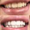 Zahnaufhellung Erfahrung - Mund mit Vorherbild Nachherbild von weißen Zähnen