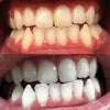 Vorher Nachher Bilder von PAP+ Zahnbleaching Zahnpasta von Diamond Smile