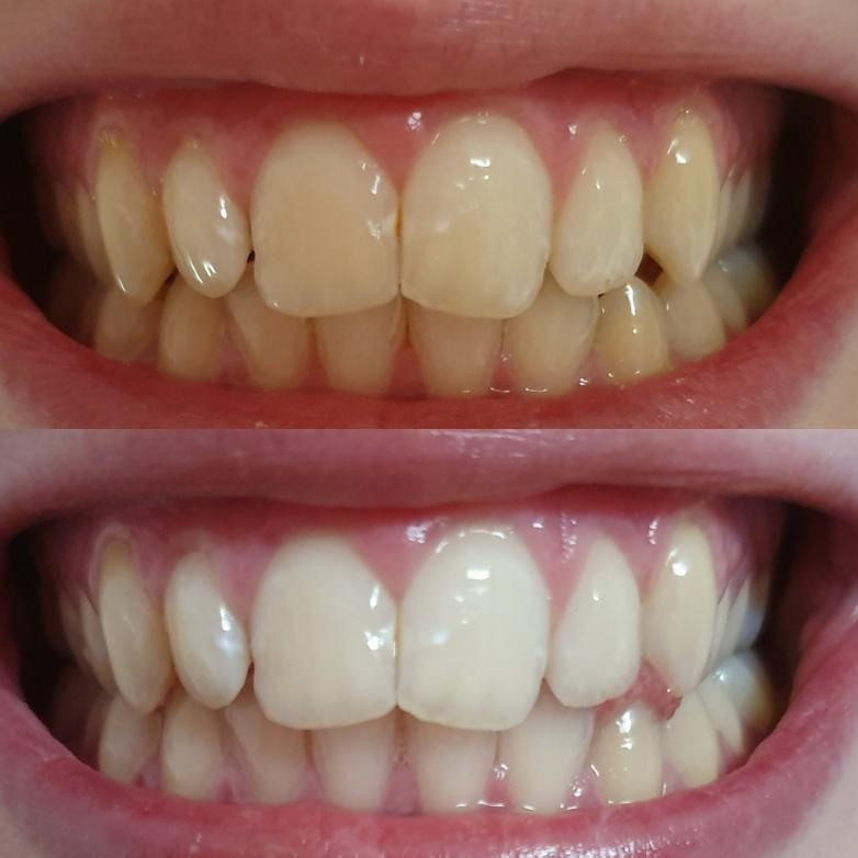Weiße und Gelbe Zähne. Weiße Zähne nach Zahnaufhellung mit Zahnbleaching Gel. Zähne aufhellen durch Zahnbleaching.