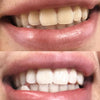 Zähne aufhellen Erfahrung - Mund mit Vorherbild Nachherbild von weißen Zähnen