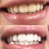Uśmiech przed i po wybielaniu zębów zestawem Diamond Smile PAP+