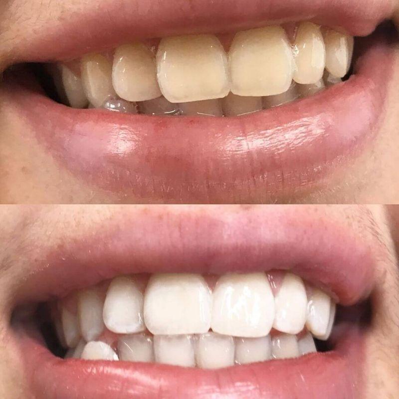 Uśmiech przed i po wybielaniu zębów zestawem Diamond Smile PAP+