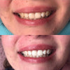 Kobieta trzyma nakładkę LED i urządzenie do wybielania zębów Diamond Smile PAP+