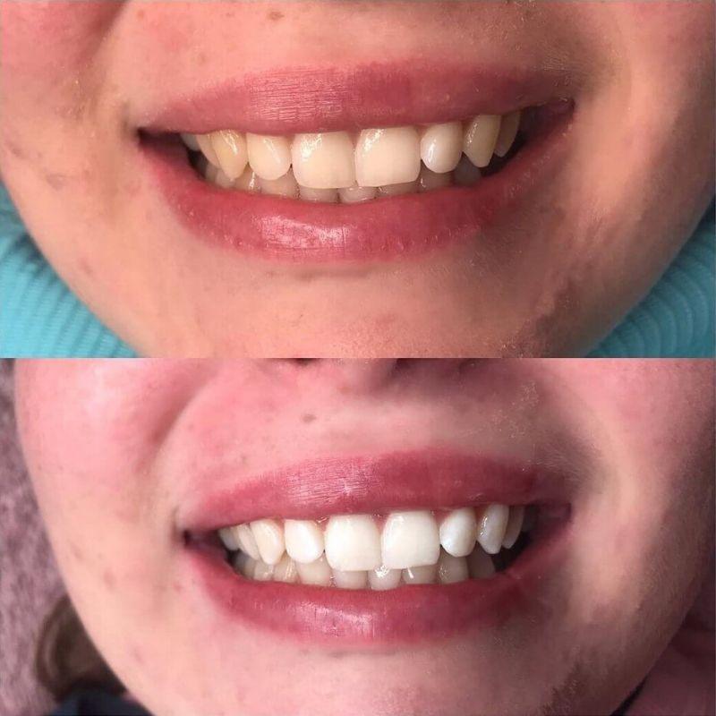 Kobieta trzyma nakładkę LED i urządzenie do wybielania zębów Diamond Smile PAP+