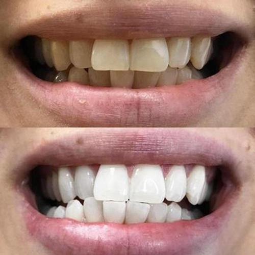 Zbliżenie uśmiechu przed i po zastosowaniu pisaka Diamond Smile – zęby wyraźnie bielsze.