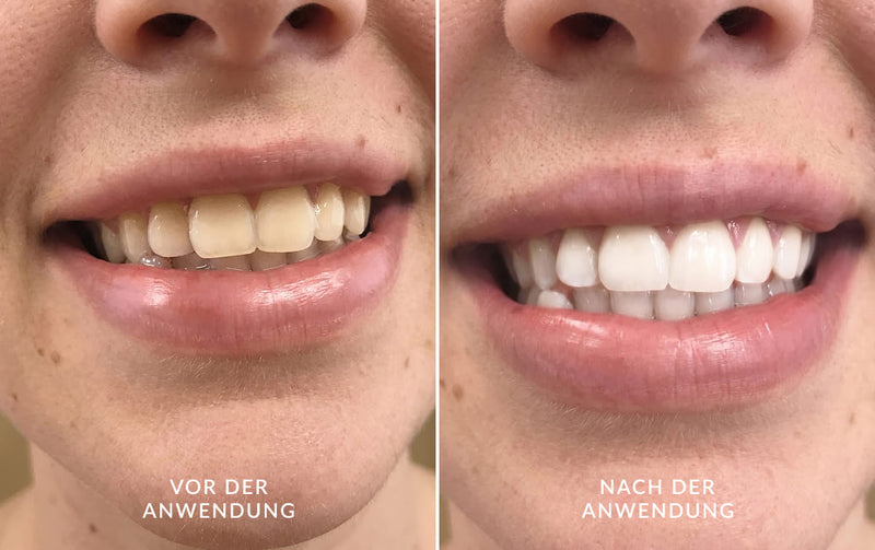 Vorher-Nachher-Vergleich der Zähne nach Anwendung des DiamondSmile Zahnaufhellungssets