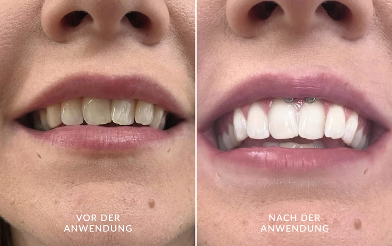 Vorher-Nachher-Vergleich der Zähne nach Anwendung des DiamondSmile Zahnaufhellungssets