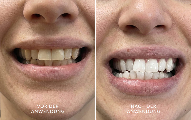 Vorher-Nachher-Vergleich der Zähne nach Anwendung des DiamondSmile Zahnaufhellungssets