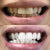 Zähne aufhellen für weiße Zähne. Auf dem Bild ein vorher nachher Bild von Zähnen nach dem Zahnbleaching.