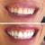 Weiße Zähne nach dem aufhellen der Zähne mit einem Zahnbleaching Set.