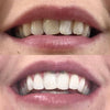 Weiße Zähne mit Zahnweiß Stift - Zahnbleaching